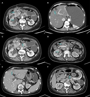 Efficacy and challenges of anti-PD1 in MSI-H mCRC: a case report on concurrent infections and ir-AIHA